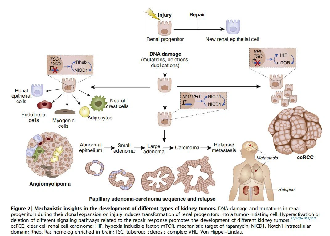 Mechanistic insights in the development of different types of kidney tumors. Mechanistic insights in the development of different types of kidney tumors.