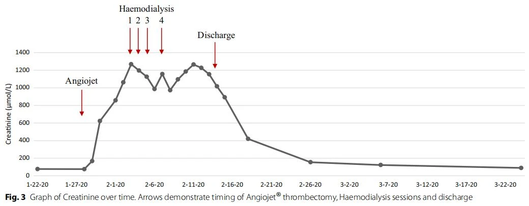 Graph of Creatinine over time. Arrows demonstrate timing of Angiojet® thrombectomy, Haemodialysis sessions and discharge Graph of Creatinine over time. Arrows demonstrate timing of Angiojet® thrombectomy, Haemodialysis sessions and discharge